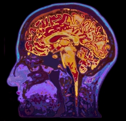 MRI image of a person's head